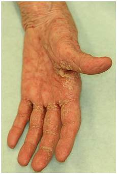 Scabies Medicine