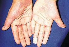 Scabies Medicine
