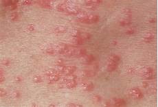 Scabies Medicine